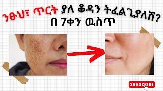 ETHIOPIA|| በቤት ውስጥ ማድያትን፤ ጥቋቁር ምልክቶችን በአንድ ሳምንት ውስጥ ከ ፊት ላይ ማጥፊያ