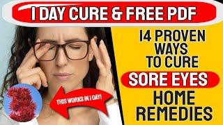 1 Day Cure With This Natural Oil ???? 14 NATURAL REMEDY FOR SORE EYES ????️ Natural Remedy For SORE 